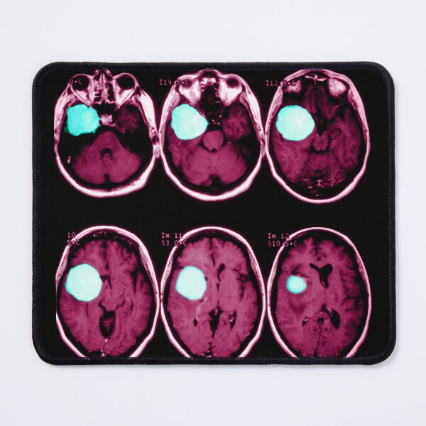 Item preview, MRI scan of a Brain Tumor, Medical Scan designed and sold by ScienceSource.