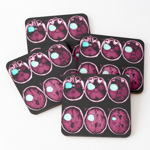Item preview, MRI scan of a Brain Tumor, Medical Scan designed and sold by ScienceSource.