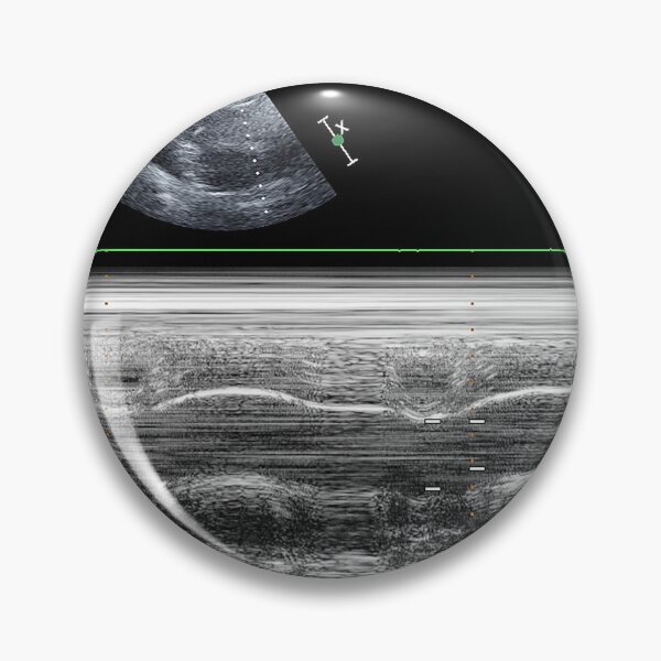 Item preview, Standard transthoracic two-dimensional echocardiography in a patient with hypertension designed and sold by KARTICK DUTTA.