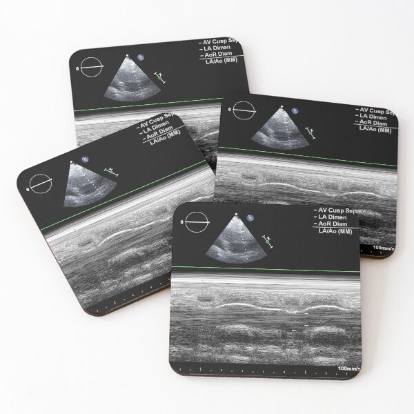 Item preview, Standard transthoracic two-dimensional echocardiography in a patient with hypertension designed and sold by KARTICK DUTTA.