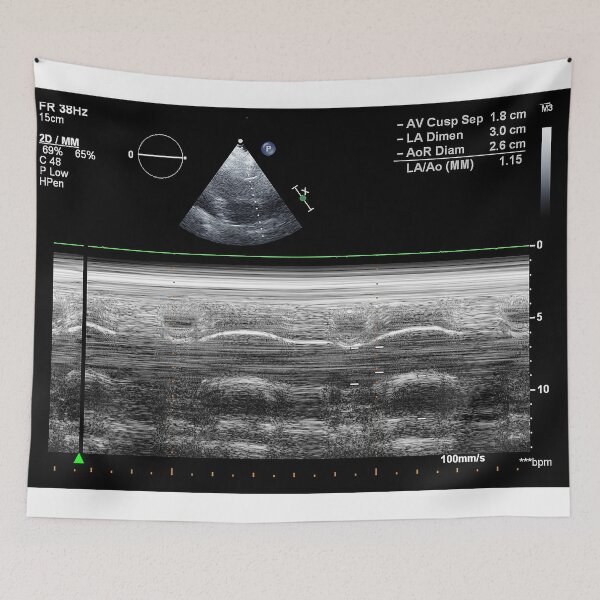 Item preview, Standard transthoracic two-dimensional echocardiography in a patient with hypertension designed and sold by KARTICK DUTTA.