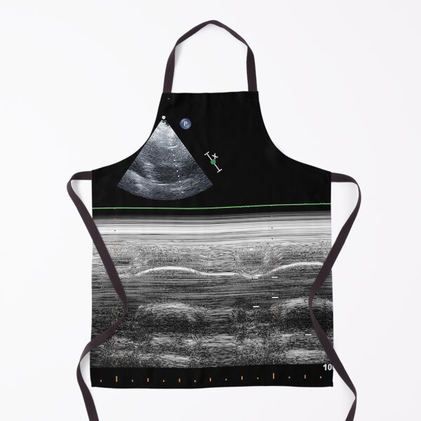 Item preview, Standard transthoracic two-dimensional echocardiography in a patient with hypertension designed and sold by KARTICK DUTTA.