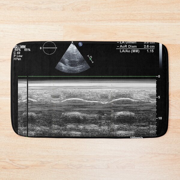 Item preview, Standard transthoracic two-dimensional echocardiography in a patient with hypertension designed and sold by KARTICK DUTTA.