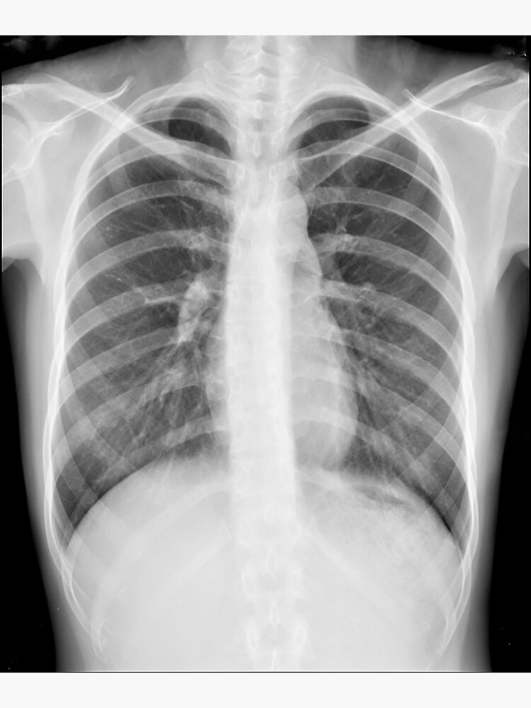 "Chest xray" Poster for Sale by RonDoyle Redbubble