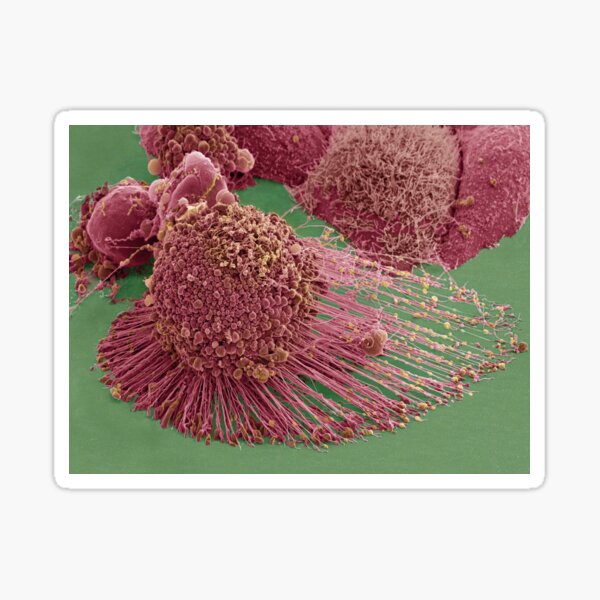 Item preview, Apoptotic HeLa Cell, SEM, Microscope Photo of Cancer Cell designed and sold by ScienceSource.