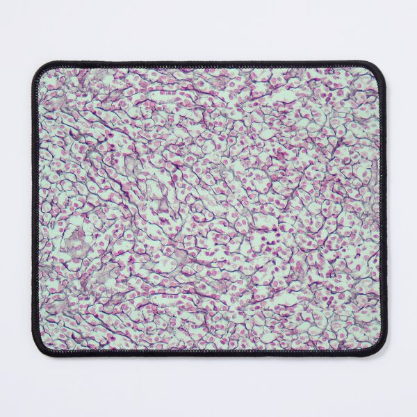 Item preview, Lymph node - Gordon and Sweets stain designed and sold by Damien Harkin.