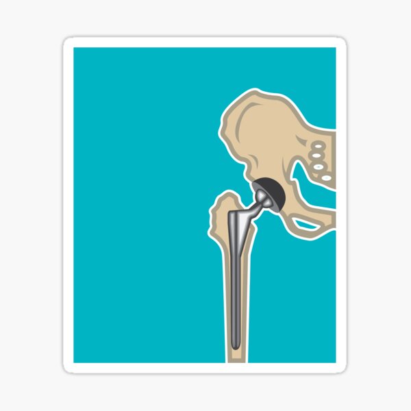 Item preview, Hip Joint replacement designed and sold by vectorworks51.