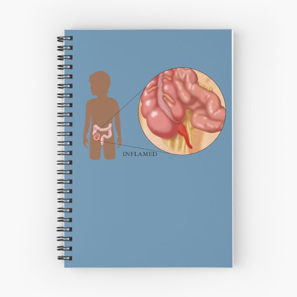 Item preview, Medical Illustration of an Inflamed Appendix, Appendicitis designed and sold by ScienceSource.
