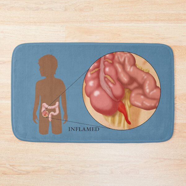 Item preview, Medical Illustration of an Inflamed Appendix, Appendicitis designed and sold by ScienceSource.