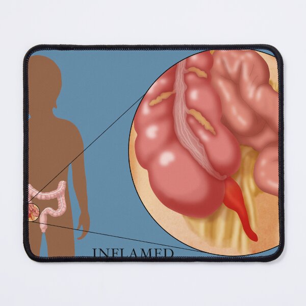 Item preview, Medical Illustration of an Inflamed Appendix, Appendicitis designed and sold by ScienceSource.