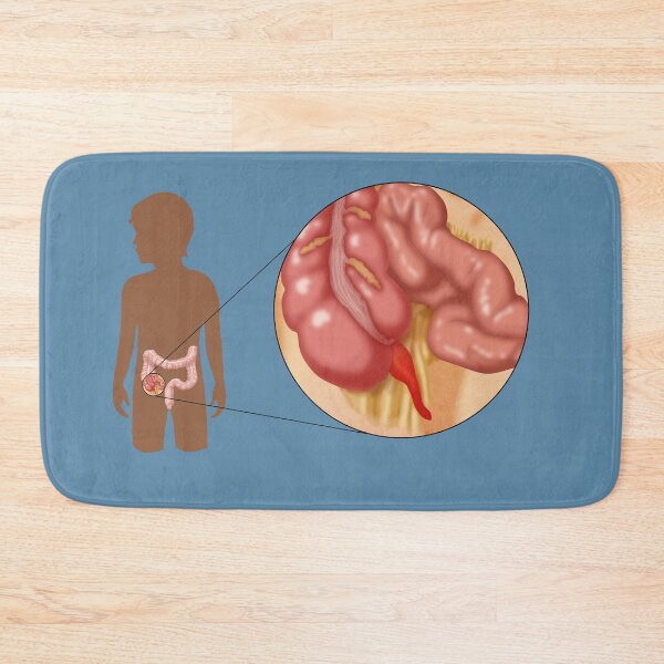 Item preview, Medical Illustration of an Inflamed Appendix, Appendicitis designed and sold by ScienceSource.