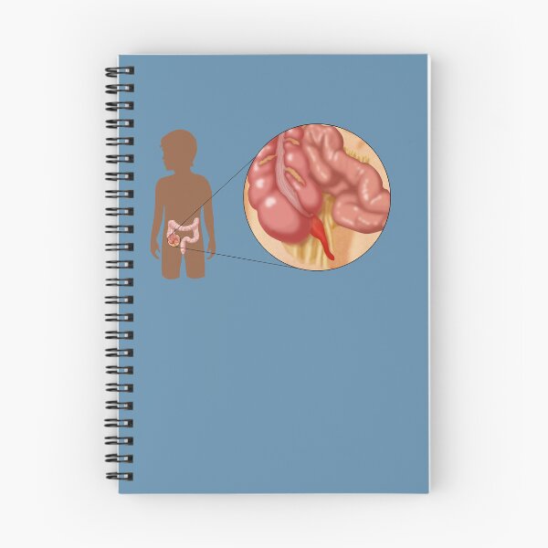 Item preview, Medical Illustration of an Inflamed Appendix, Appendicitis designed and sold by ScienceSource.