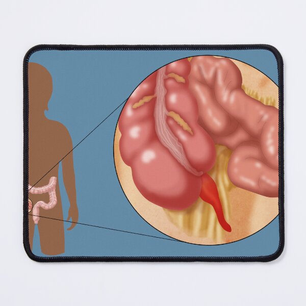 Item preview, Medical Illustration of an Inflamed Appendix, Appendicitis designed and sold by ScienceSource.