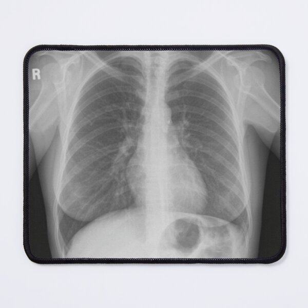 Item preview, Chest X-Ray designed and sold by rcmarble.