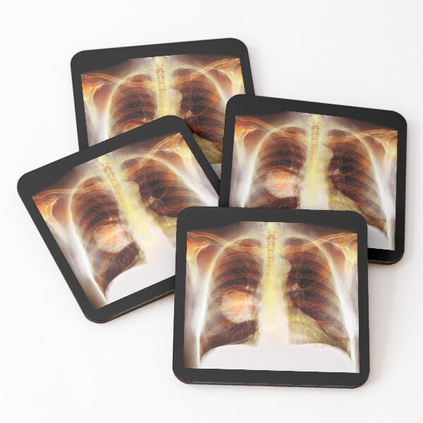 Item preview, Chest X-Ray designed and sold by rcmarble.
