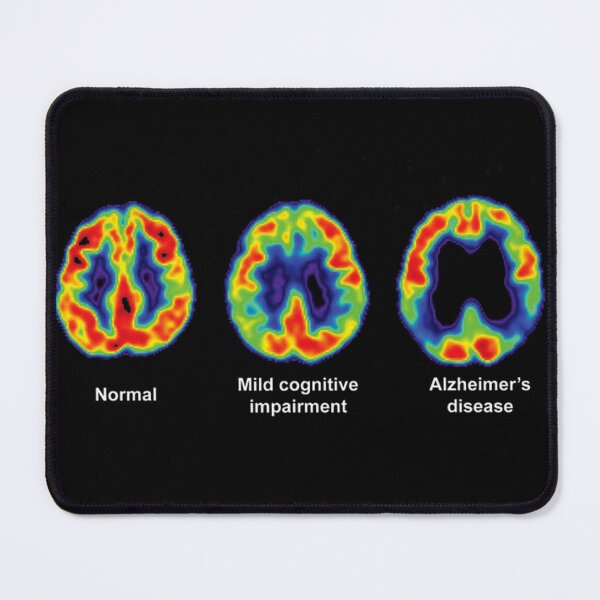 Artikelvorschau, Normale, beeinträchtigte und Alzheimer-Gehirn-PET-Scans entworfen und verkauft von ScienceSource.