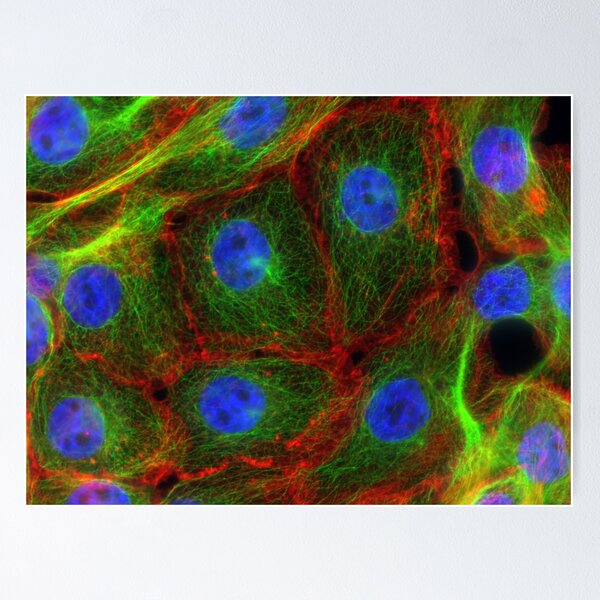 Item preview, Breast Cancer Cells, FM, Microscope designed and sold by ScienceSource.