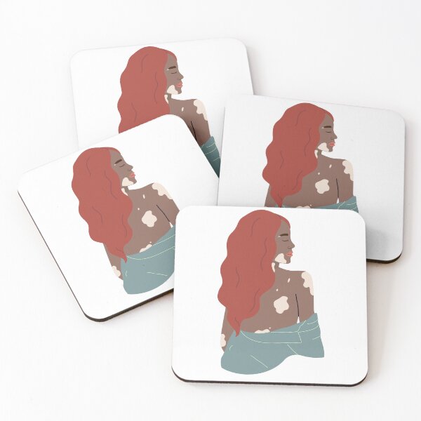 Item preview, Vitiligo Mermaid designed and sold by Marielc19.