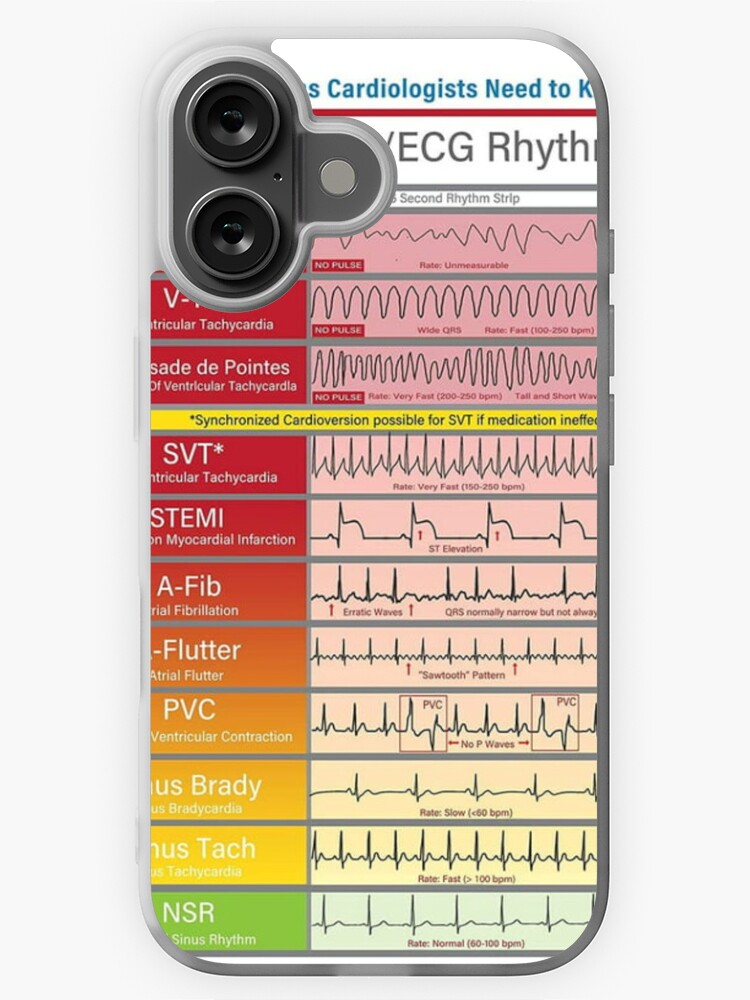 P Wave What Does Ecg Mean On Apple Watch Pvcs Ekg Iphone Ecg Ekg