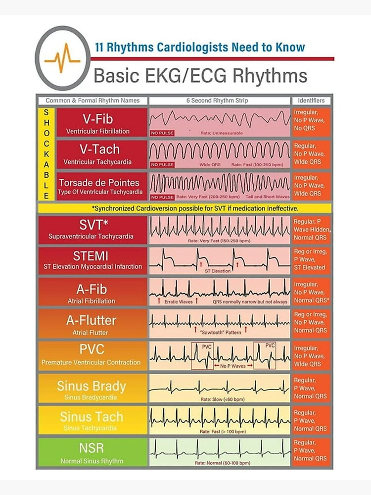 Ecg Ekg basics Knowledge  | Journal