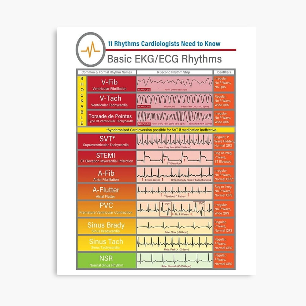 Ecg Ekg basics Knowledge  | Journal