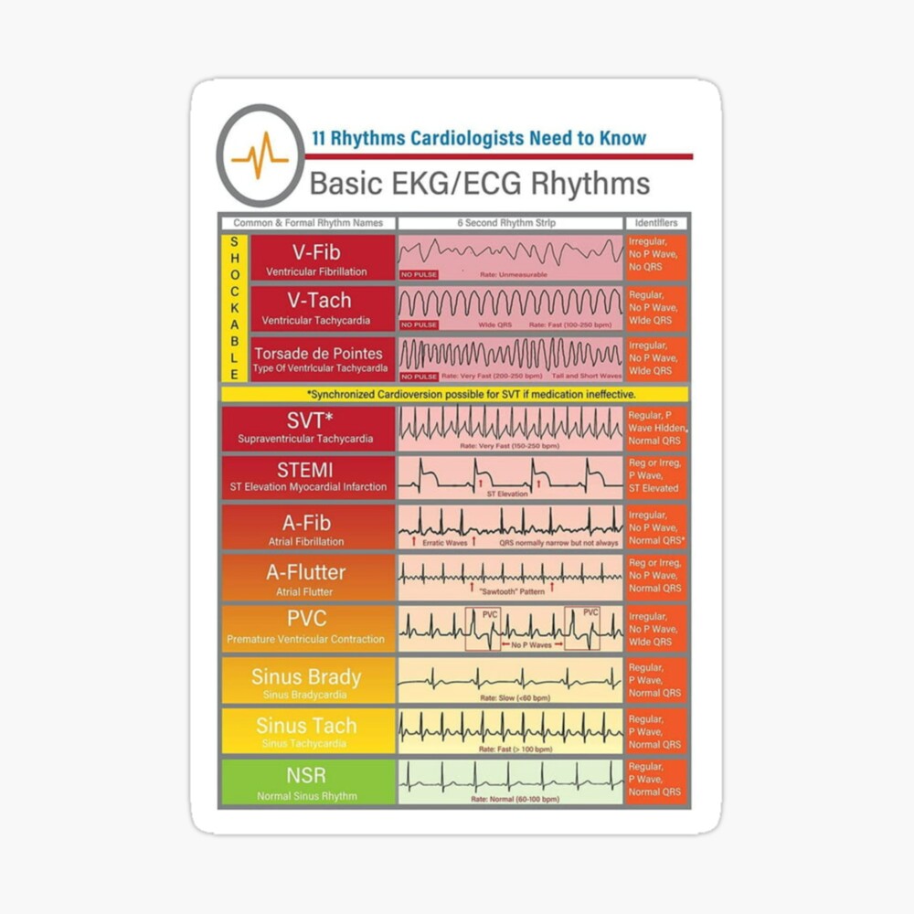 Ecg Ekg basics Knowledge  | Journal