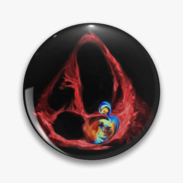 Item preview, Mitral regurgitation PISA designed and sold by EchoArtUK.