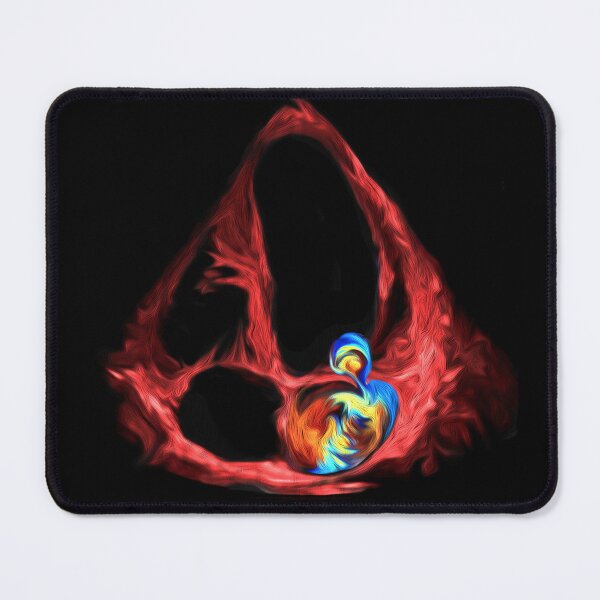 Item preview, Mitral regurgitation PISA designed and sold by EchoArtUK.