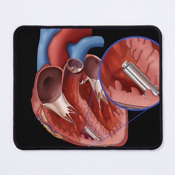 Item preview, Leadless Pacemaker, Medical Illustration designed and sold by ScienceSource.