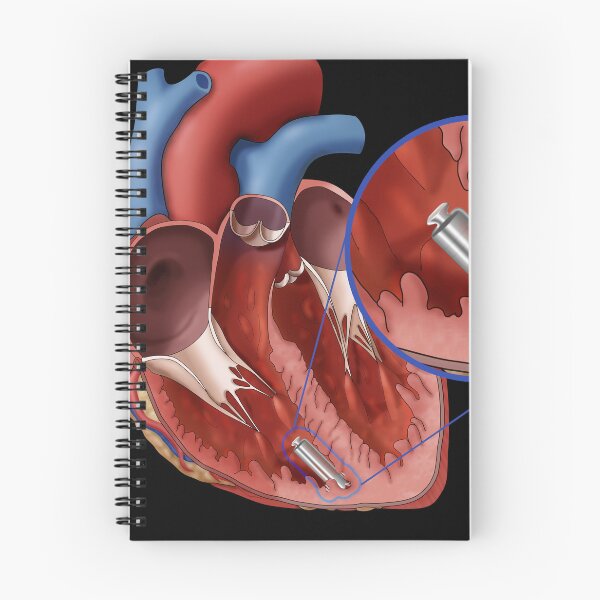 Item preview, Leadless Pacemaker, Medical Illustration designed and sold by ScienceSource.