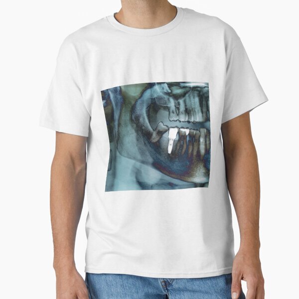 Item preview, Dental implant, X-ray (C040/3268) designed and sold by SciencePhoto.