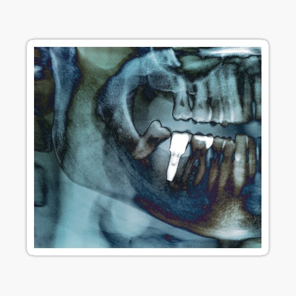 Item preview, Dental implant, X-ray (C040/3268) designed and sold by SciencePhoto.