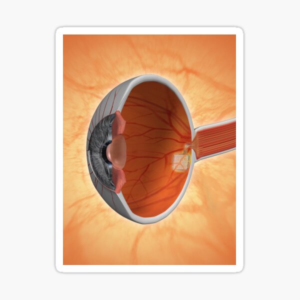 Retinal Implant Sticker