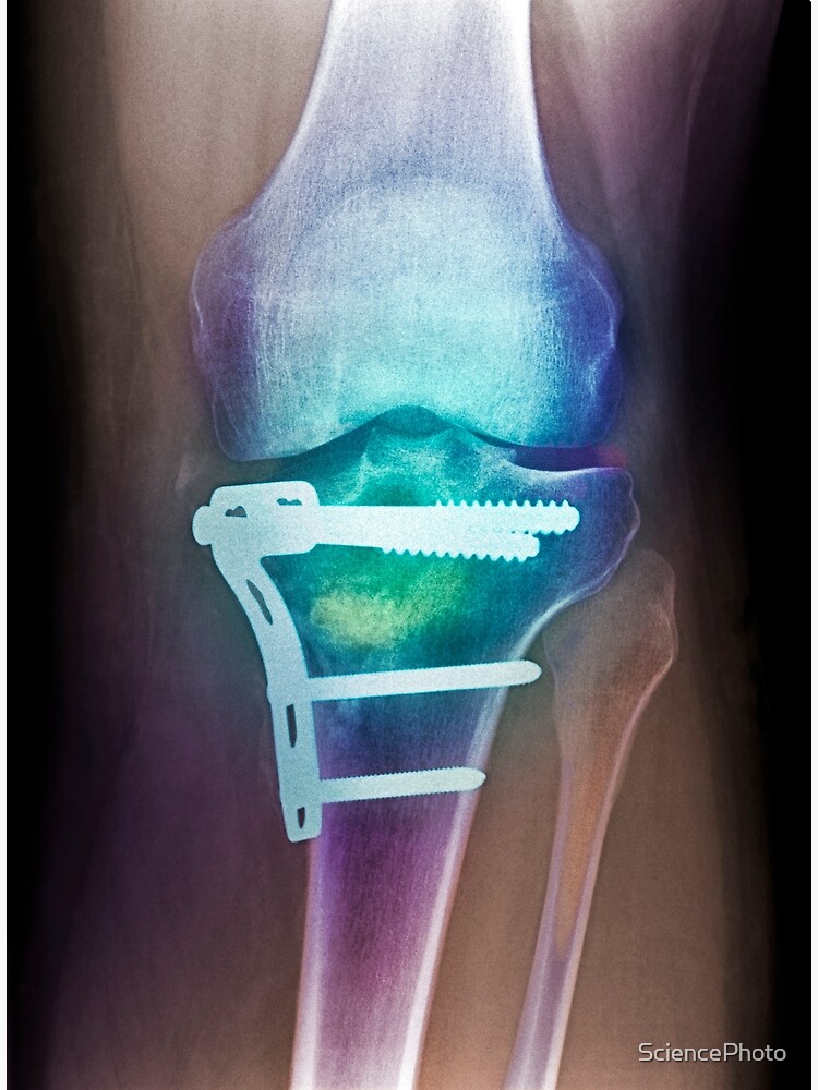 Skeleton X-ray Legging With Bone Plates & Screws - Designed By