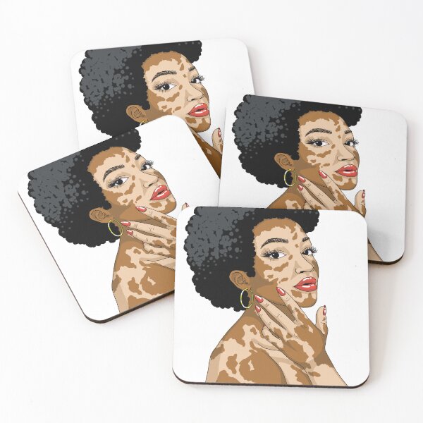 Item preview, Vitiligo Queen designed and sold by Kalanipenn.