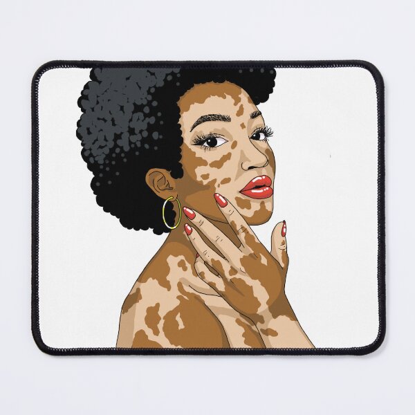 Item preview, Vitiligo Queen designed and sold by Kalanipenn.