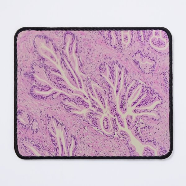 Item preview, Endocervix histology, cauterised, H&E, 40x designed and sold by Psymier.