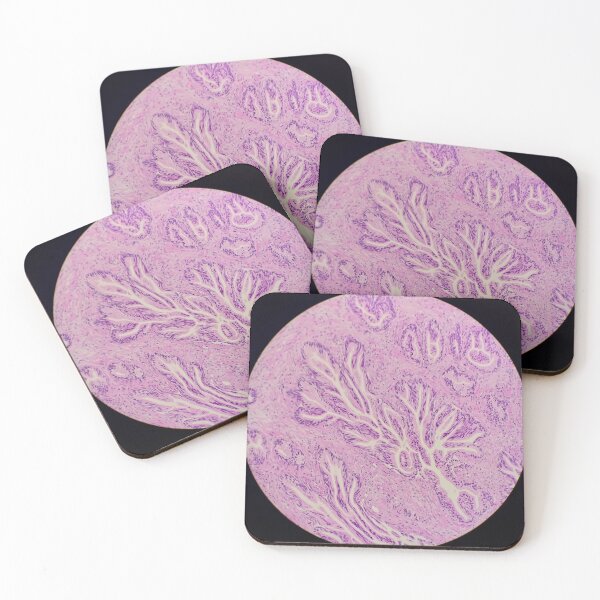 Item preview, Endocervix histology, cauterised, H&E, 40x designed and sold by Psymier.