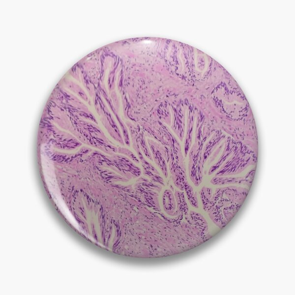 Item preview, Endocervix histology, cauterised, H&E, 40x designed and sold by Psymier.