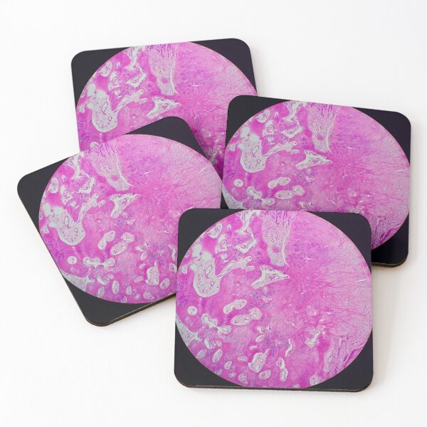Item preview, Nora lesion, bone histology, H&E, 40x  designed and sold by Psymier.