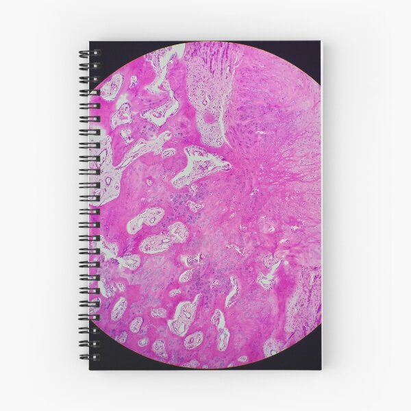 Item preview, Nora lesion, bone histology, H&E, 40x  designed and sold by Psymier.