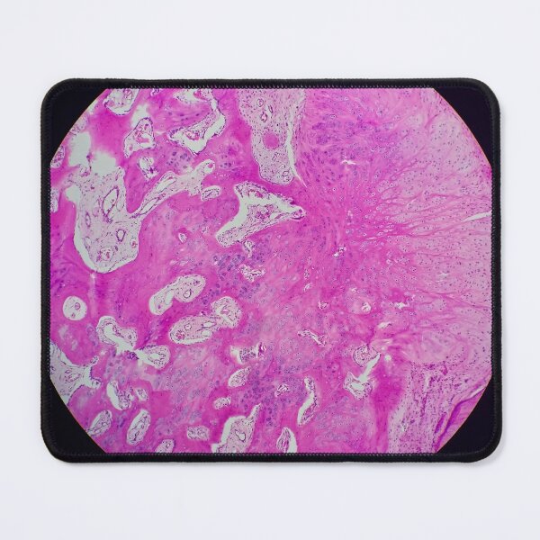 Item preview, Nora lesion, bone histology, H&E, 40x  designed and sold by Psymier.