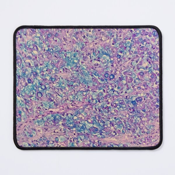 Item preview, Signet ring carcinoma, stomach histology, AB/PAS stain, 200x designed and sold by Psymier.