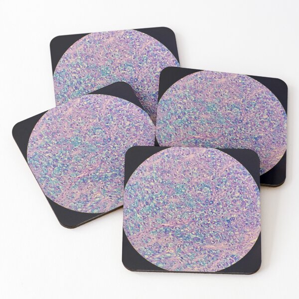 Item preview, Signet ring carcinoma, stomach histology, AB/PAS stain, 200x designed and sold by Psymier.