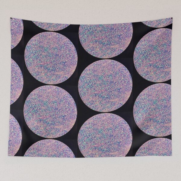 Item preview, Signet ring carcinoma, stomach histology, AB/PAS stain, 200x designed and sold by Psymier.