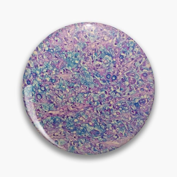 Item preview, Signet ring carcinoma, stomach histology, AB/PAS stain, 200x designed and sold by Psymier.