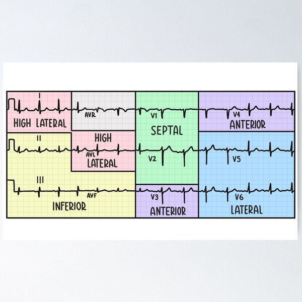 Item preview, Pastel de electrocardiograma (ECG) de 12 derivaciones dibujado a mano designed and sold by SofiaSava01.