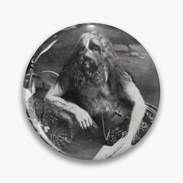 Item preview, Stephan Bibrowski, Known as the Lion Faced Man, Circus Performer. 1918 designed and sold by ScienceSource.