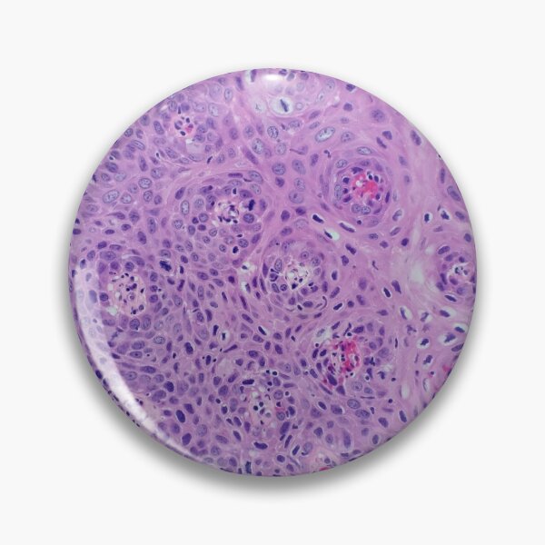 Item preview, Skin histology, tangential, dysplastic, 200x H&E designed and sold by Psymier.