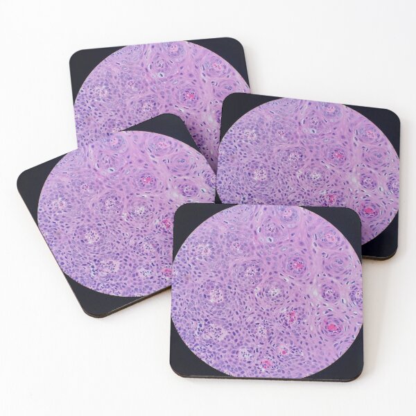 Item preview, Skin histology, tangential, dysplastic, 200x H&E designed and sold by Psymier.